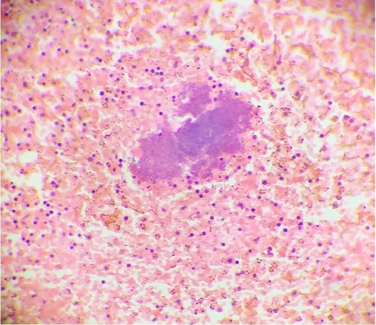 Photomicrograph of the spleen showing numerous bacterial colonies identified as Staphylococcus aureus on bacteriological examination (H&E Stain, 10x).