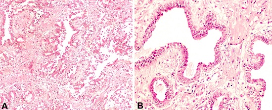 Photomicrograph of the breast parenchyma shows stromal edema, and ductal hyperplasia with mild dilation of breast ducts, with no signs of malignant transformation. A &ndash; Intralobular ducts are abundant and tortuous (H&E, 100X); B &ndash; Mild dilation of breast ducts. Scant inflammatory cells are seen in the stroma (H&E, 200X).