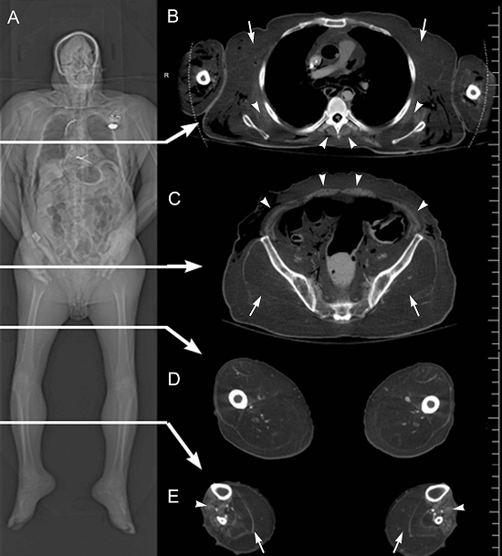 CT images from a case study of a 72-year-old white male with late-stage, adult onset muscular dystrophy. Part (A) is a frontal topogram of the entire cadaver showing diffuse fatty infiltration of skeletal muscles. Arrows indicate levels from which axial sections (B-E) are taken. In (B), the axial CT image is from mid-chest level, showing marked fat replacement of the pectoral muscles (arrows), and partial sparing of the serratus anterior and paraspinal muscles (arrowheads). Soft tissue gas in the upper arms and posterolateral back are related to the embalming process. In (C), at the level of the mid-pelvis, there is striking fatty replacement of the gluteal muscles (arrows), and partial sparing of the musculature of the abdominal wall (arrowheads). In the axial image in (D) at mid-thigh level, there is significant fatty replacement of the musculature of the anterior, posterior, and medial compartments of the thigh. The axial CT image in (E) is at the level of the mid-calf, which shows fatty replacement of the musculature of the leg, with substantial replacement and pseudohypertrophy of the posterior compartment musculature (arrows), and partial sparing of the anterior compartment musculature (arrowheads).