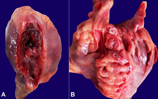 Gross view of the cut section of the heart depicting in A &ndash; dark mottled area consistent with a trans-mural MI taken; B &ndash; LAD proper and at its bifurcation show a fibrous cap fibroatheroma (AHA Grade 6) with luminal narrowing of about 80 to 90% with overlying plaque erosion.