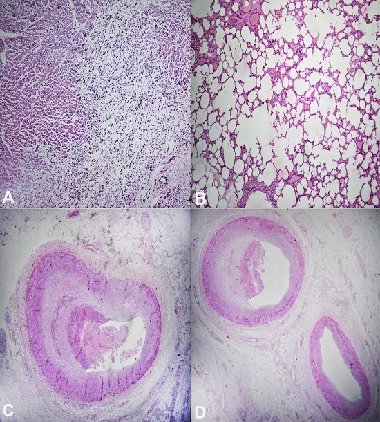 Photomicrographs of the myocardium in A, lung in B, coronaries in C and D. A &ndash; shows recent infarction with early granulation tissue formation at the edge of the infarct; B &ndash; lung with diffuse alveolar damage and emphysematous changes; C &ndash; shows atherosclerosis with a near occlusive recent thrombus of LAD proper; and D &ndash; shows atherosclerosis with mural thrombus in the short LAD.