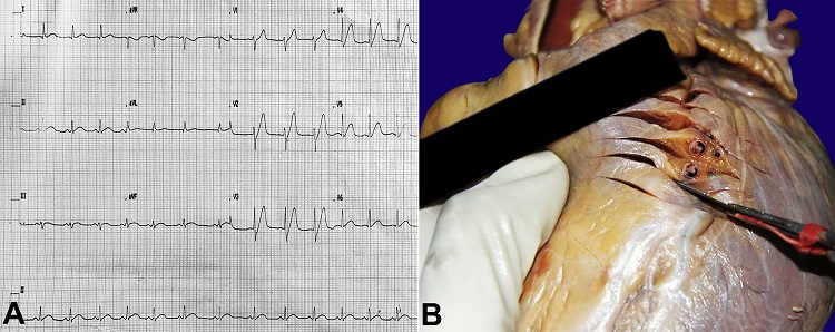ECG and gross findings. A &ndash; ECG showing hyperacute T waves in V1, V2, and V3 leads; B &ndash; Occlusion of LAD artery at its proximal part. ECG = electrocardiogram; LAD = left anterior descending