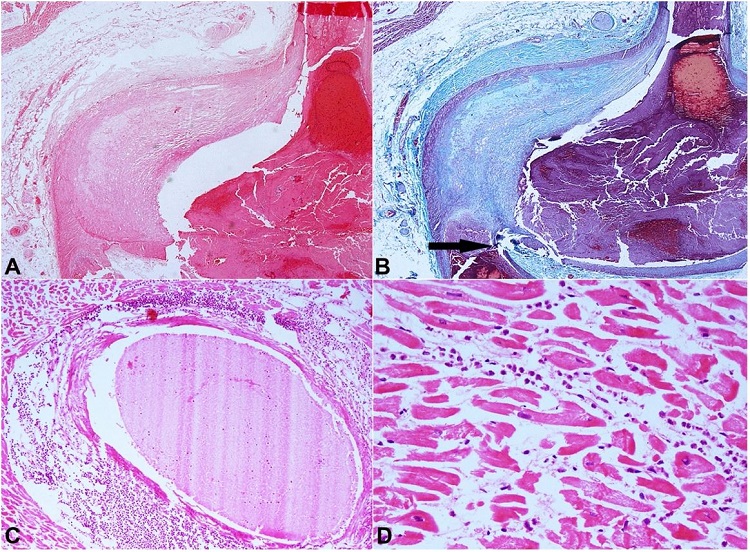 Photomicrographs of the heart. A &ndash; Low-power magnification shows marked intimal thickening of the left anterior descending artery wall and fresh fibrin thrombi in the arterial lumen (H&E, 20X); B &ndash; Masson trichrome stain highlights the markedly thickened intima as light green color (20X). The arrow points to the intimal plaque rupture with hemorrhage; C &ndash; The myocardium shows perivascular collections of neutrophils which are also spilling into surrounding the cardiomyocytes (H&E, 40X); D &ndash; Scattered neutrophils within the myocardium causing destruction of the myocytes. Also note the loss of nuclei and presence of contraction bands in these fibers (H&E, 100X).