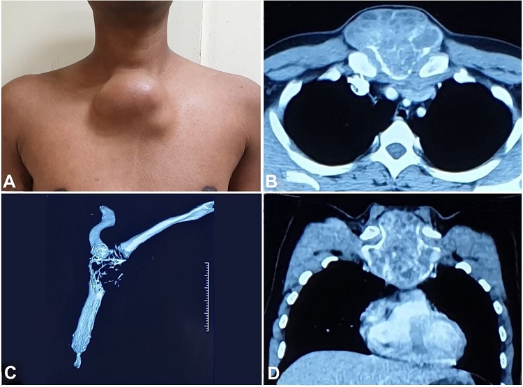 A – Clinical photograph of the patient showing a lobulated swelling over the manubrium sterni; B-D – Contrast-enhanced computed tomography showing expansile lytic lesion involving manubrium sterni and proximal body of sternum with large heterogeneously enhancing soft tissue component, peripheral rim of calcification and contiguous infiltration of adjacent pectoralis major (B – Axial plane; C – Sternal 3D reconstruction; D – Coronal plane).