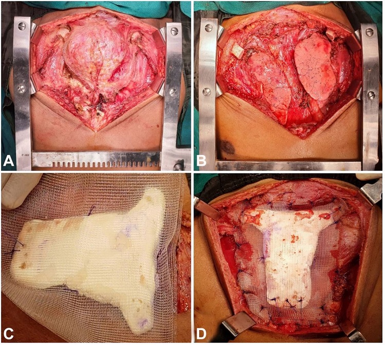 A – Intra-operative image showing the tumor extent; B – Chest wall defect post-resection; C – Sternal prosthesis prepared using PMMA; D – Reconstruction using sternal prosthesis.