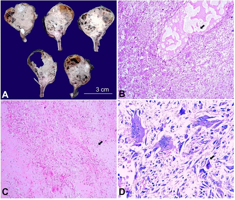 A – Photograph of wide local excision of the sternal mass showing a solid cystic tumor of tan-white to tan-grey solid mass with areas of hemorrhage; (B-D) – Histopathological examination showed a cellular, osteoclastic cell-rich lesion with aneurysmal bone cyst-like areas (B, H& E, 100X), extracellular osteoid formation (C, H& E, 100x) and marked cellular and nuclear pleomorphism with atypical mitotic figures (D, H& E, 400x).