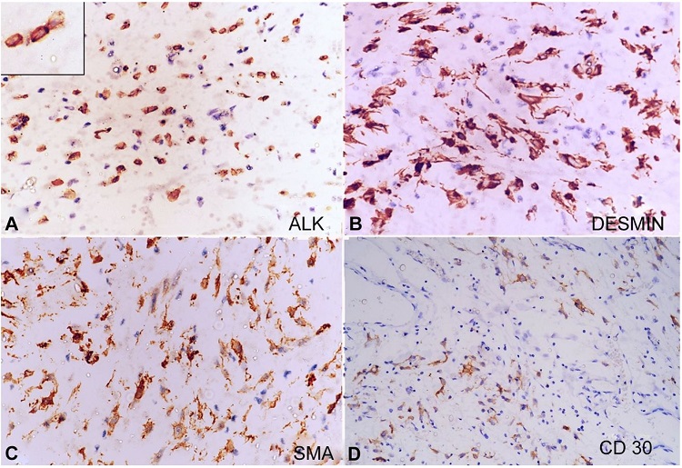 Immunohistochemistry. A &ndash; Tumor cells showing ALK nuclear membranous positivity (inset) (x400); B &ndash; Diffuse desmin positivity (x400); C &ndash; SMA positivity (x400); D &ndash; Focal CD30 positivity (x200).