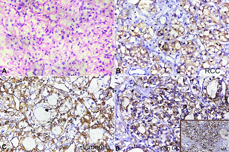 A &ndash; A tumor comprised of clear cells arranged in clusters. The cells have abundant clear-to-vacuolated cytoplasm and a central round nucleus showing mild pleomorphism. Nucleoli are inconspicuous (H&E 400X). B &ndash; Tumor cells showing strong membranous staining with RCC antigen (400X). C &ndash; Tumor cells showing strong membranous staining with vimentin. D &ndash; Tumor cells showing no staining with SMA (400X). RCC = renal cell carcinoma; SMA = smooth muscle actin.