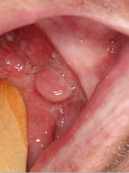 Clinical features of recurrent SpSCC after radiotherapy at the same site of previous conventional well-differentiated SCC. Polypoid nodular lesion on the floor of the mouth and tongue, surrounded by erythematous areas.