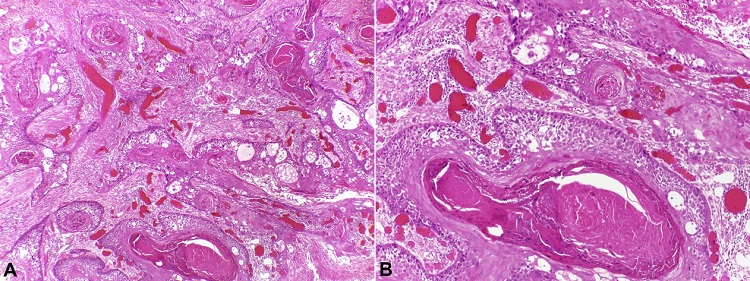 Histopathological features of oral SCC: neoplastic epithelium with conventional pattern (Original magnification, A, x10; B, x20) (H&E stain).
