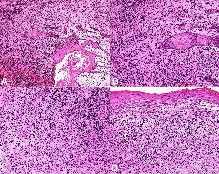 Histopathological features of SpSCC: Biphasic tumor consisting of infiltrating neoplastic epithelium in close relationship to spindle cells (H&E, A, x10; B, x20). Dysplastic epithelium and overt pleomorphism of the spindle cells in the sarcomatoid component (H&E, C, x20; D, x20).