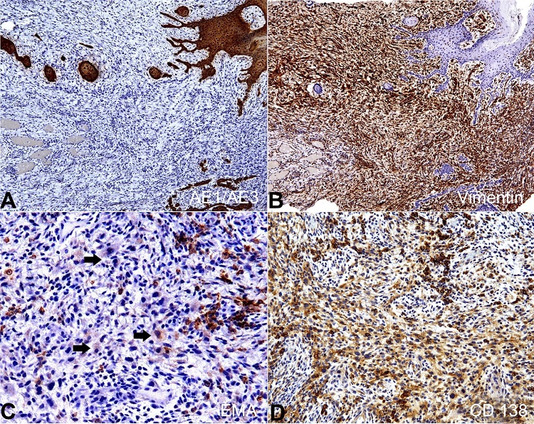 Immunohistochemical analysis of the SpSCC on consecutive serial tissue sections. A &ndash; Positive reaction for CK AE1/AE3 in the carcinomatous component; B &ndash; Vimentin highlighted the sarcomatoid component; C &ndash; EMA expression was weak and detected scarce sarcomatoid cells (arrows); D &ndash; CD138 evidenced both carcinomatous and sarcomatoid components (A and B x10, C x40 and D x20).