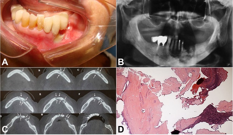 A &ndash; Exposure of bone and alveolar ridge in the region of teeth #33 and #34 an intraoral aspect; B &ndash; Area of bone sequestration spreads across the body of the mandible (symphysis region) to the region of pre-molars; C &ndash; Cone-beam computed tomography; D &ndash;Histological exam &ndash; H&E stained section showing completely necrotic bone trabeculae