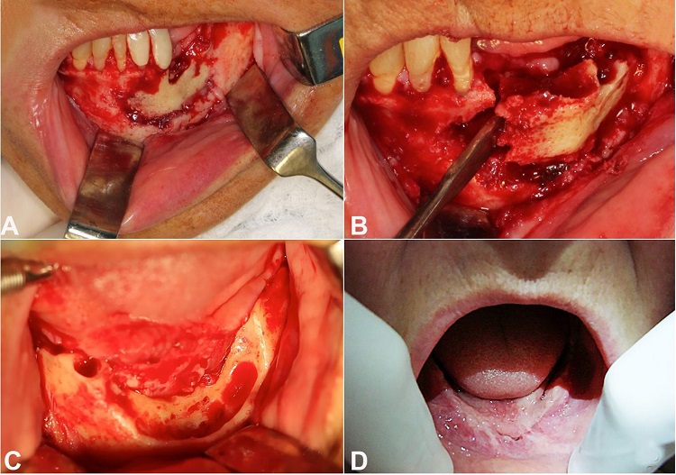 A &ndash; Necrotic area involving bone and teeth; B &ndash; Surgical treatment with removal of bone sequestration; C &ndash; After the removal of bone sequestration and teeth; D &ndash; Surgical follow up (7 days). No sign of new bone exposure and/or surgical wound dehiscence.