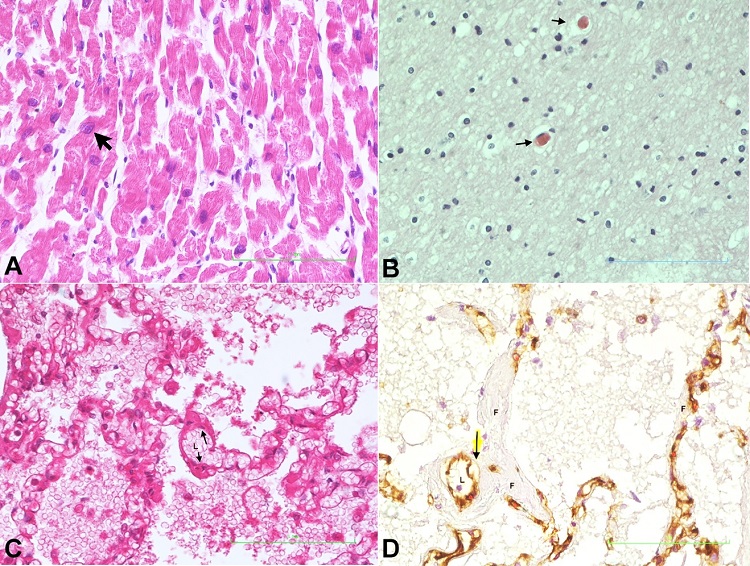 Photomicrographs of: A &ndash; Cardiomyocyte showing enlarged nucleus (arrow) (H&E x 400); B &ndash; Brain showing thrombotic microangiopathy (arrows) (H&E x 400); C &ndash; Alveolar-capillary section showing subendothelial fibrin deposits (arrows) lumen represented as L (H&E x 200); D &ndash; Pulmonary section showing unstained subendothelial fibrin deposits (F), brown-stained endothelial cells (arrow) with lumen free of thrombus (L) (CD31 stain x 400).