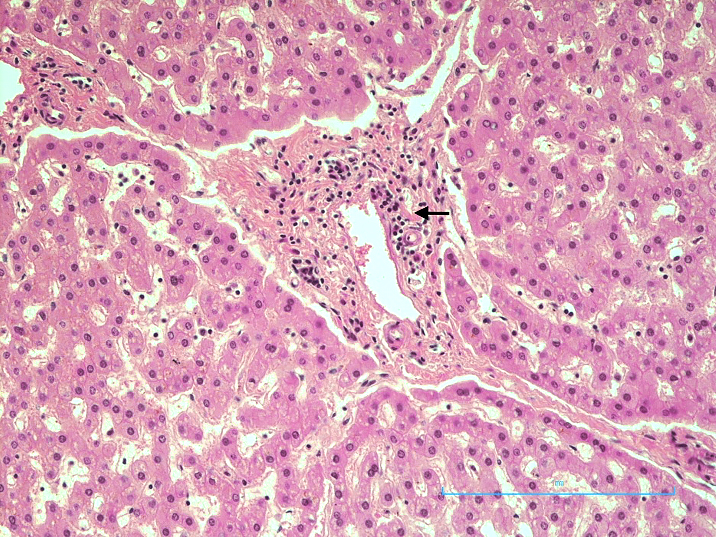 Photomicrograph of the liver showing portal triaditis (H&E x 200).