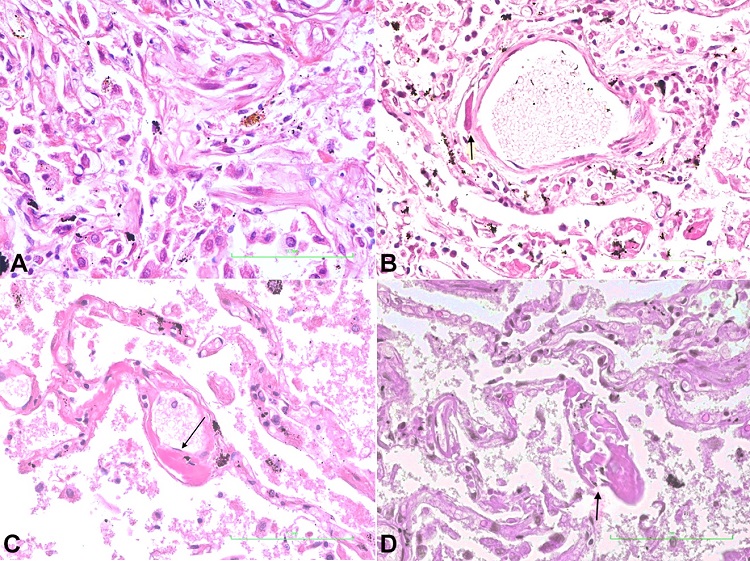 Photomicrographs of the lung. A &ndash; Pulmonary section showing interstitial pneumonia (H&E, x 400); B &ndash; Pulmonary section showing fibrin deposit (arrow) within the wall of a venule (H&E, x 400); C &ndash; Pulmonary section showing subendothelial deposit in a capillary (arrow) (H&E, x 400); D &ndash; Pulmonary section showing fibrin deposit in subendothelial location and subsequent destruction of the capillary wall (arrow) (H&E, x 400).