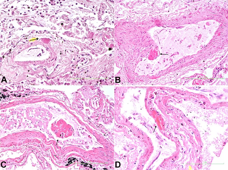 Photomicrographs of the lung. A &ndash; Pulmonary arteriole showing fibrin deposit in the adventitia (arrow) (H&E x 400); B &ndash; Pulmonary artery showing fibrin deposit underlying endothelial layer (arrow) (H&E x 400); C &ndash; Detached thrombus (arrow) in pulmonary vein (H&E x 400); D &ndash; Pulmonary post-capillary venule showing fibrin deposit underlying endothelial layer (arrow) (H&E x 400).