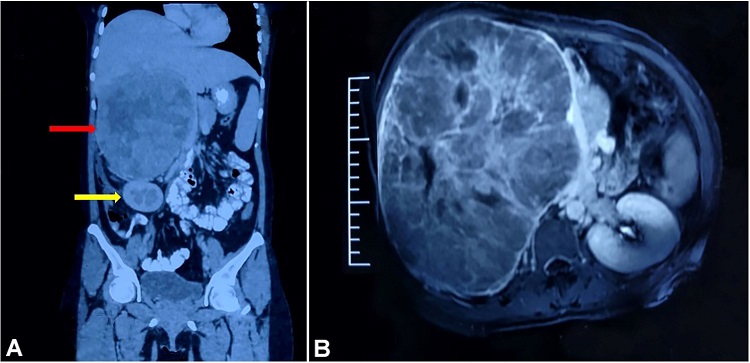 A and B &ndash; CECT showing a large solid hypodense lesion measuring 24&times;20&times;16 cm, in the right adrenal area displacing the portal vein, pancreas and IVC to the left side (red arrow). Mass is also compressing right kidney (yellow arrow).