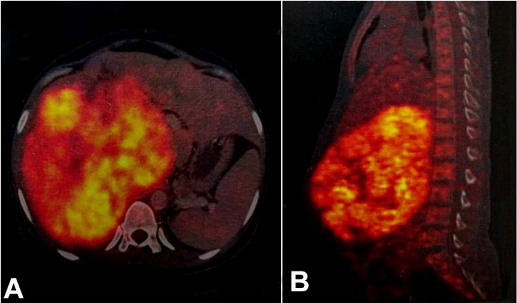 A and B &ndash; PET-CT showing large FDG avid heterogeneously enhancing lobulated soft tissue density mass lesion in the right suprarenal region. Right adrenal gland was not separately visualized.
