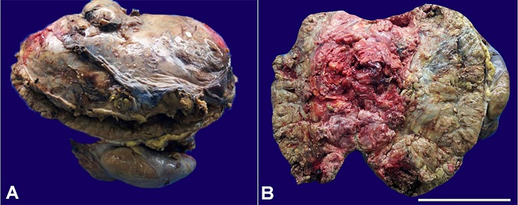 A and B &ndash; Gross of giant adrenal mass measuring 29&times;20&times;12 cm with cut surface showing a variegated appearance and large areas of necrosis. (Scale bar = 10 cm)