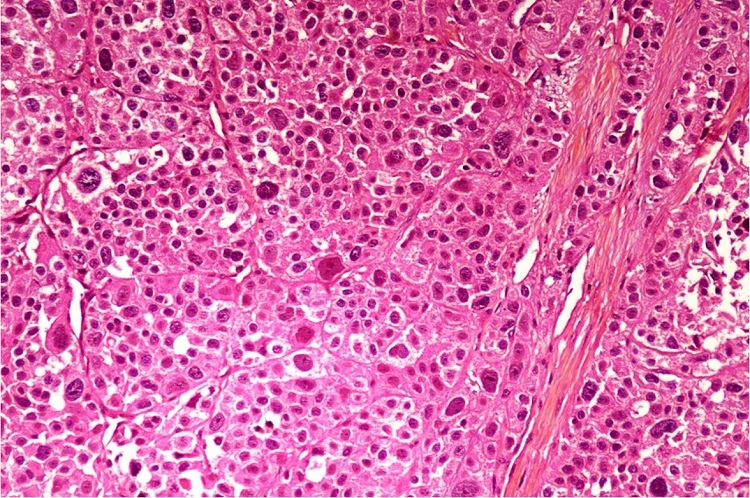Photomicrograph showing highly cellular tumor composed of cells having markedly pleomorphic round to oval nuclei, coarse granular chromatin, prominent nucleoli and moderate amount of eosinophilic to clear cytoplasm. Many bizarre cells and brisk mitotic activity is also present (H&E; 40x).
