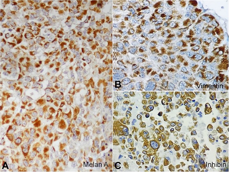A and B &ndash; Tumor cells showing strong cytoplasmic positivity for Melan A & Vimentin (Figure 5A-B); C &ndash; Focal weak positivity for Inhibin (IHC; 40x) (Figure 5C).