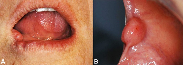 Clinical features of the intraoral OFMT. A &ndash; A painless nodule in the anterior region of buccal mucosa with approximately 2 years of duration; B &ndash; A well-circumscribed submucosal nodule with a smooth surface and normochromic in the anterior region of buccal mucosa measuring 1.3 cm in maximum diameter.
