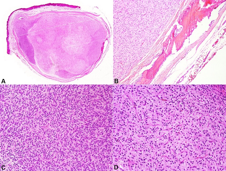 Photomicrographs of the intraoral ossifying fibromyxoid tumor. A &ndash; A well-circumscribed tumor with a complete fibrous capsule that extended fibrous septa, separating the hypercellular area from other areas (H&E, 1.44x); B &ndash; Peripheral shell of lamellar bone within the fibrous capsule (H&E, 5x); C &ndash; The cells range from small round to oval to fusiform shapes, with bland nuclei with fine chromatin and indistinct cytoplasm borders. The hypercellular area exhibited less intercellular matrix, often showing nuclear overlapping (H&E, 20x); D &ndash; Intermediate cellularity (H&E, 20x).