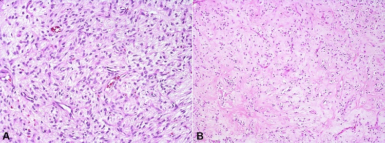 Photomicrographs of the intraoral ossifying fibromyxoid tumor. A &ndash; Hypocellular area with abundant fibromyxoid matrix (H&E, 20x); B &ndash; Hyaline material in the center of the lesion resembling chondroid or osteoid material (H&E, 10x).