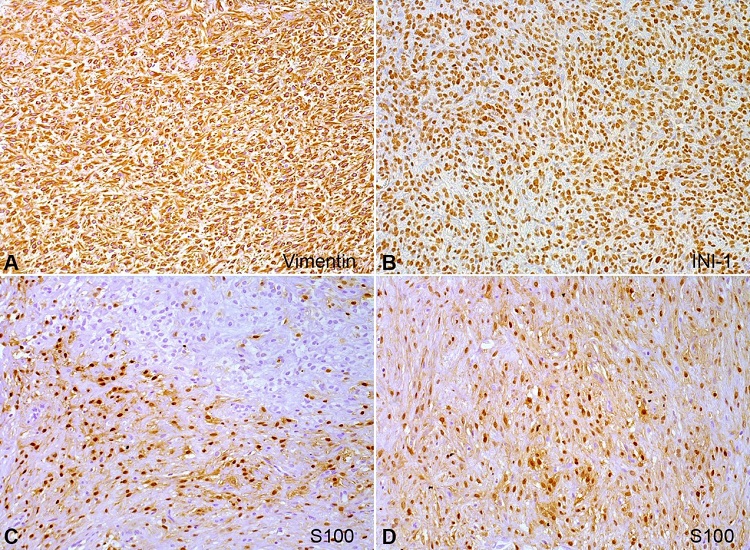 Immunohistochemical reactions of the intraoral ossifying fibromyxoid tumor. A &ndash; Vimentin showed cytoplasmic positivity in all tumor cells (20x); B &ndash; Intact nuclear expression of INI-1 in all tumor cells (20x); C &ndash; S100 exhibit nuclear positivity in the tumor cells; D &ndash; mainly in fibromyxoid and hyaline areas (20x).