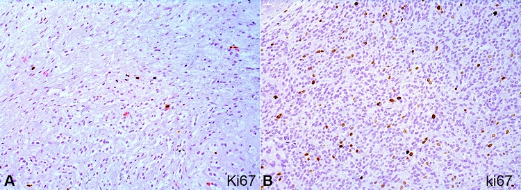 Immunohistochemical reactions of the intraoral ossifying fibromyxoid tumor. A &ndash; Ki67 was low (< 5%); B &ndash; however, in the hypercellular area had an increased rate (< 10%) (immunohistochemistry, 20x).