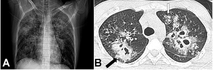 A – Chest x-ray showing bilateral heterogeneous opacities in the pulmonary parenchyma; B – Thoracic computed tomography showing bilateral upper lobe nodules of varying size and multiple cavitations. One of the them shows intracavity content (black arrow). Ground glass opacities surrounding a few nodules in the left upper lobe (halo sign; white arrow).