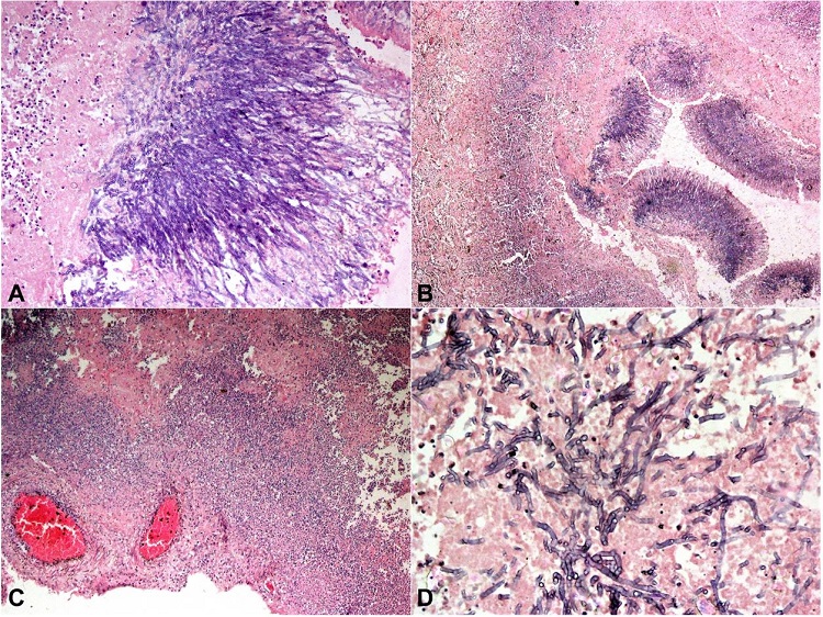 A and B – Photomicrographs of the lungs showing fungal abscess (blue staining), acutely branching septate hyphal elements of Aspergillus spp. with heavy infiltration of neutrophils with the background of necrotic lung tissues (H&E A 10X, and B 4X); C and D – Photomicrographs of the brain; C – showing necrosis, heavy neutrophil infiltration with thrombosed vessels (H&E, 4X); D – Multiple blue-stained septate fungal hyphae (H&E, 40X).