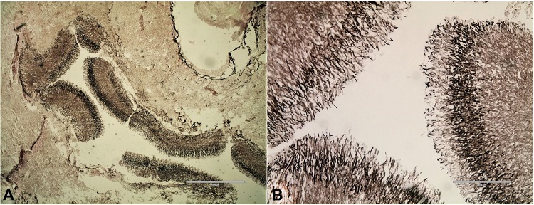 Photomicrograph of the brain. A and B – show acutely branching septate hyphal elements of aspergillus (Grocott’s staining A 4X, and B 10X).