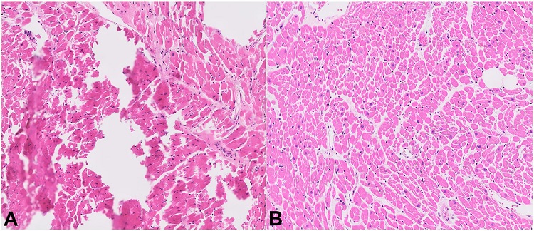 Comparison of control tissue and formalin pre-fixed tissue. A &ndash; Histology of a tissue section taken from the right heart ventricle demonstrating artifacts; tissue was sectioned fresh without formalin pre-fixation (control); B &ndash; Improved histology of a tissue section taken from the right heart ventricle after formalin pre-fixation and subsequent tissue sectioning.