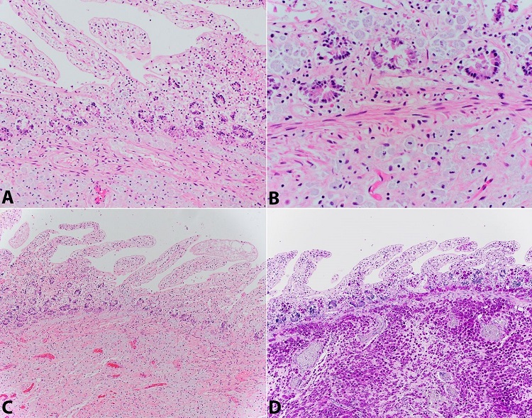 Photomicrographs of the small bowel. A &ndash; Foamy histiocytes with ingested T. whipplei organisms (H&E, 200x); B &ndash; Mucosa/submucosa transition with foamy histiocytes with ingested T. whipplei organisms (H&E, 400x); C &ndash; Foamy histiocytes with ingested T. whipplei organisms (H&E, 100x); D &ndash;T. whipplei organisms positive with PAS-D stain (100x).