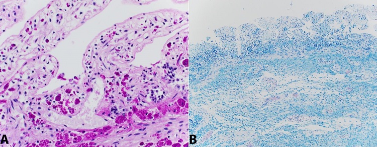 Photomicrograph of the small bowel. A &ndash; positive PAS-D stain highlighting individual organisms at high power (400x); B &ndash; Absence of acid-fast bacilli (AFB) on modified Ziehl-Neelsen AFB stain (100x)