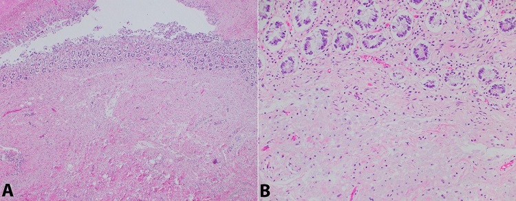 Photomicrograph of the colon. A &ndash; Right colon demonstrating predominantly lamina propria and mural involvement by foamy histiocytes (H&E, 40x); B &ndash; Right colon demonstrating predominantly mural involvement by foamy histiocytes (H&E, 200x).
