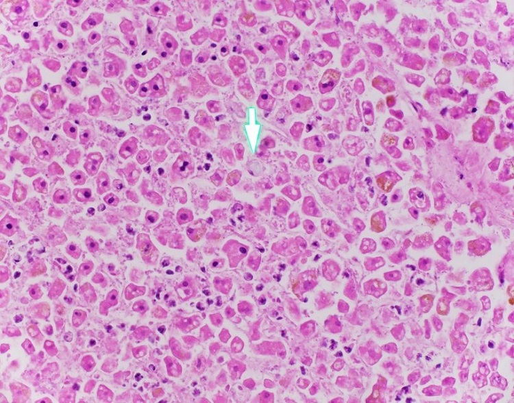 Photomicrograph of the liver with rare foamy histiocyte (arrow) in sinusoid (H&E, 400x).