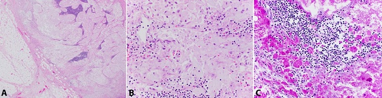 Photomicrograph of the lymph node. A &ndash; Lymph node edge with sparse lymphoid tissue predominantly replaced by histiocytes (H&E, 40x); B &ndash; Lymph node with organism laden histiocytes (H&E, 400x); C &ndash; Lymph node with organisms highlighted by positive PAS-D stain (400x).