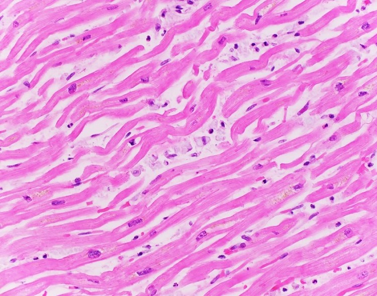 Photomicrograph of the myocardium with rare foamy histiocytes without associated myocarditis (H&E, 400x)