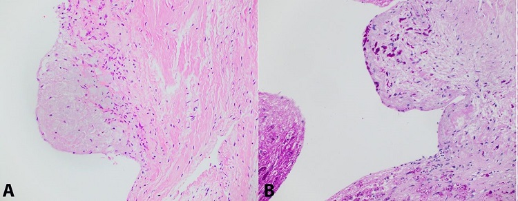 Photomicrograph of the cardiac valves. A &ndash; Mitral valve vegetation composed of organism laden histiocytes (H&E, 200x); B &ndash; Mitral valve vegetation, positive PAS-D stain (200x).