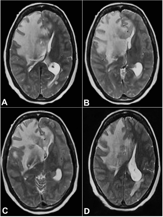 MRI axial T2 W image at the level of basal ganglia and body of lateral ventricle showing diffuse edema at the right frontal white matter and capsule-ganglionic region with expansion of frontal lobe, compression of ipsilateral lateral ventricle and contralateral midline shift along with focal areas intermediate signal intensity noted at the right peri-frontal region and corpus callosum.