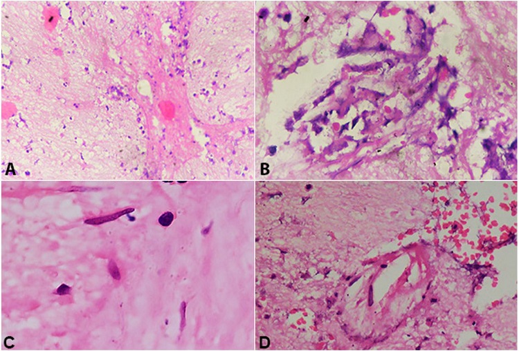 Photomicrographs of the brain tissue. A – Gliosis with inflammatory cells and focal necrosis (H&E, x10); B and C – Broad, aseptate, obtuse angle branching hyphae in necrotic background (H&E, x20, x40 respectively); D – broad aseptate branching hyphae showing angio-invasion (H&E, x40).