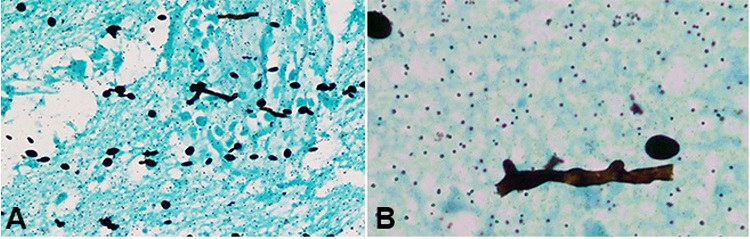 Photomicrographs of the brain tissue. A and B – Broad, aseptate, obtuse angle branching hyphae with spores in glial tissue (Gomori methenamine silver stain, x20, x100 respectively).