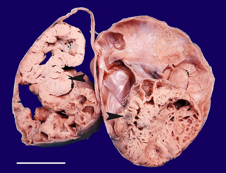 Gross view of the cut surface of the tumor with cystic and greyish-white solid area(arrowheads) that represent teratomatous component in microscopy.