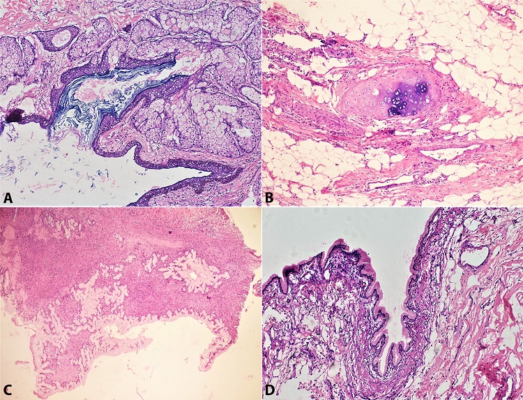 Photomicrographs of the tumor. A &ndash; Section is lined by keratinous stratified squamous epithelium. The sub epithelium shows lobules of glands (H&E,100X); B &ndash; The section shows a cartilage formation (H&E,200X); C &ndash; Part of the cyst cavity is lined by benign columnar epithelium with moderate amount of mild eosinophilic cytoplasm. Tangential cut of the glands are also noted (Frozen Section,100X); D &ndash; The section is lined by columnar glandular epithelium having basally located nucleus with bland nuclear feature and moderate amount of eosinophilic cytoplasm(H&E,100X).