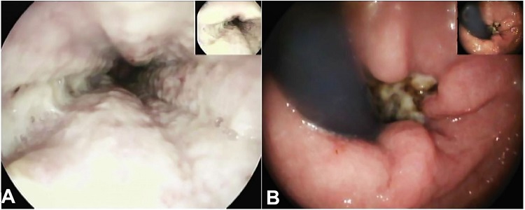 A &ndash; Upper endoscopy showing ischemic mucosa; B &ndash; Retrovision of the cardia showing the gastroesophageal transition with an ischemic esophageal mucosa.