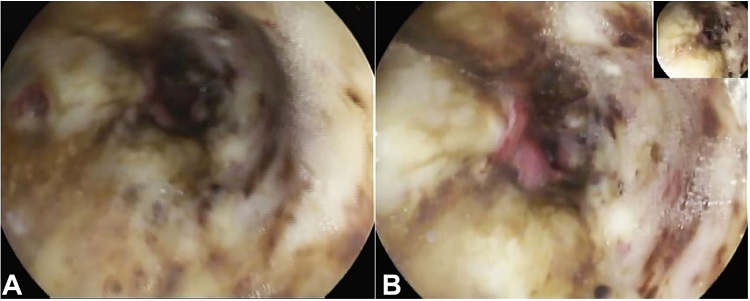 A and B &ndash; Upper endoscopy showing ischemic mucosa.
